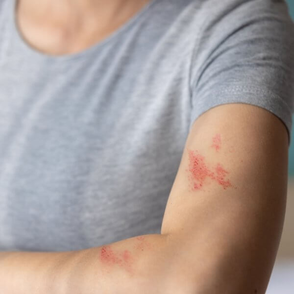 ¿Sabías que la culebrilla es causada por el mismo virus de la varicela?